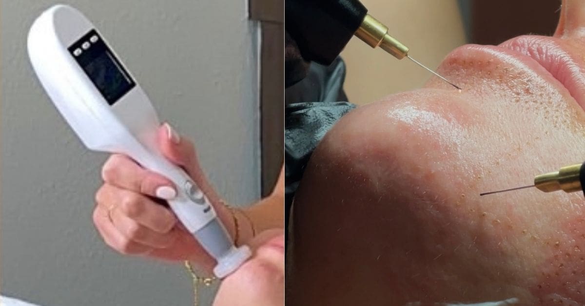 Fibroblast and Jet Plasma in Los Angeles